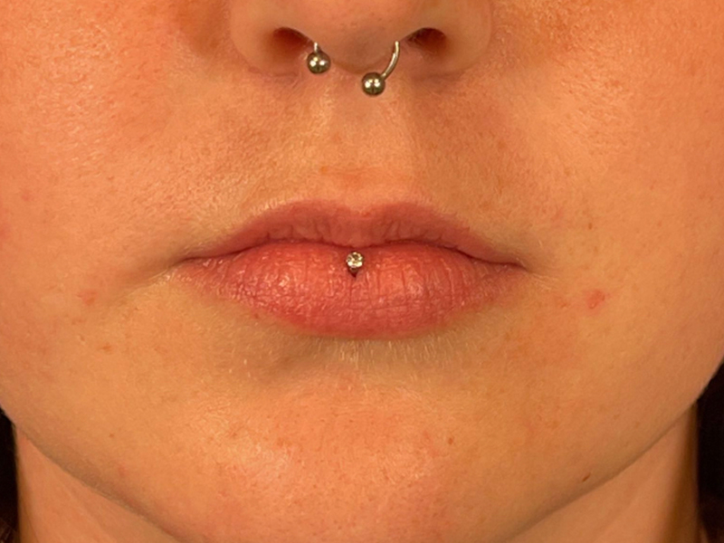 Lip Filler Before and After | Plastic Surgery Associates of Valdosta