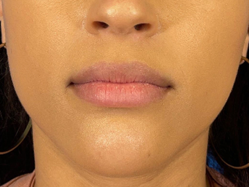 Lip Filler Before and After | Plastic Surgery Associates of Valdosta