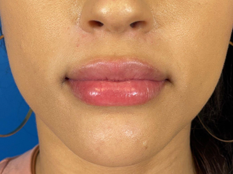 Lip Filler Before and After | Plastic Surgery Associates of Valdosta