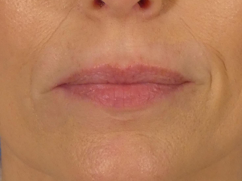 Lip Filler Before and After | Plastic Surgery Associates of Valdosta