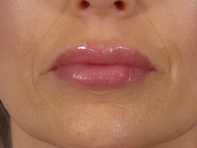 Lip Filler Before and After | Plastic Surgery Associates of Valdosta