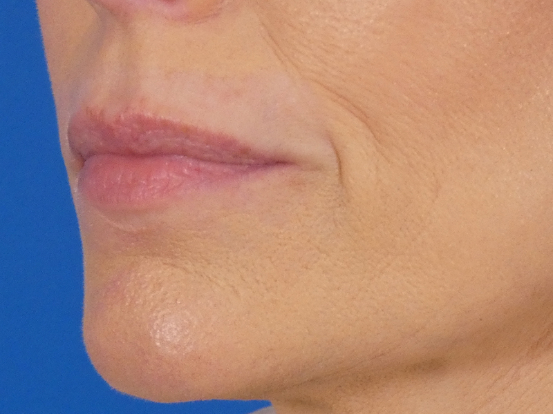 Lip Filler Before and After | Plastic Surgery Associates of Valdosta