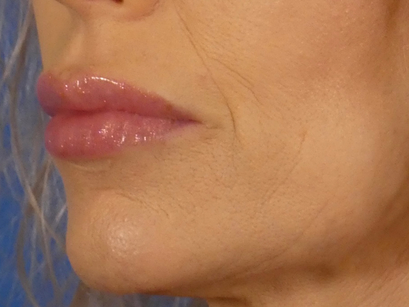 Lip Filler Before and After | Plastic Surgery Associates of Valdosta