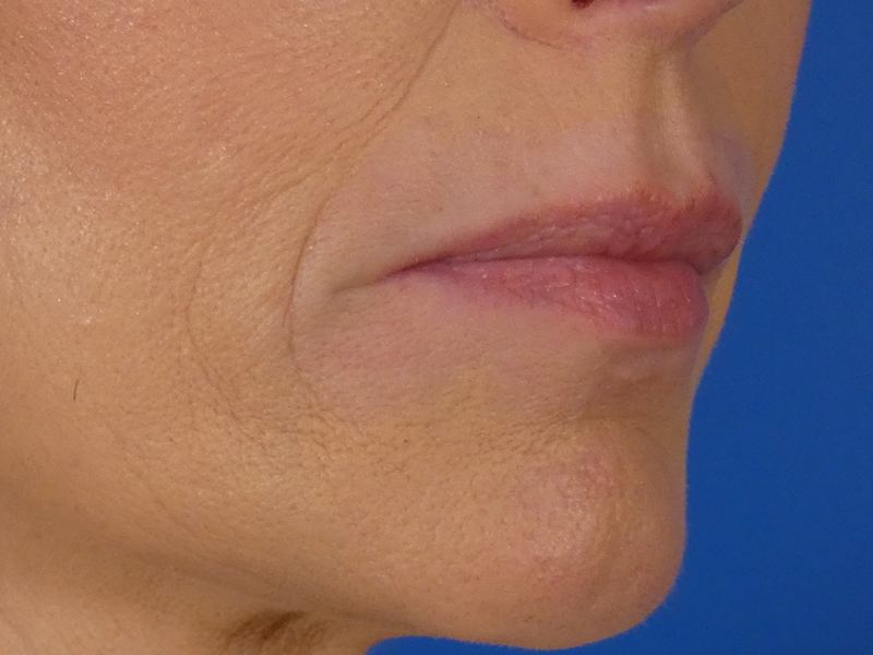 Lip Filler Before and After | Plastic Surgery Associates of Valdosta