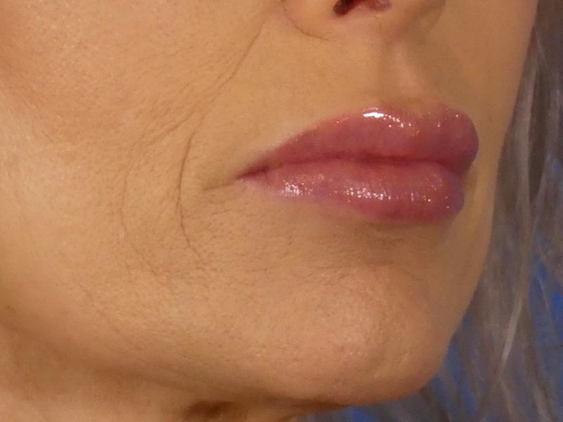 Lip Filler Before and After | Plastic Surgery Associates of Valdosta