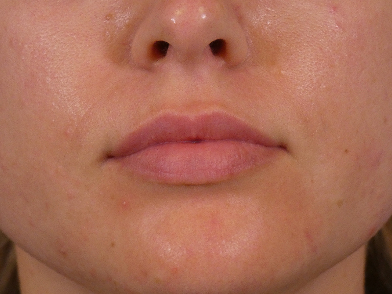 Lip Filler Before and After | Plastic Surgery Associates of Valdosta