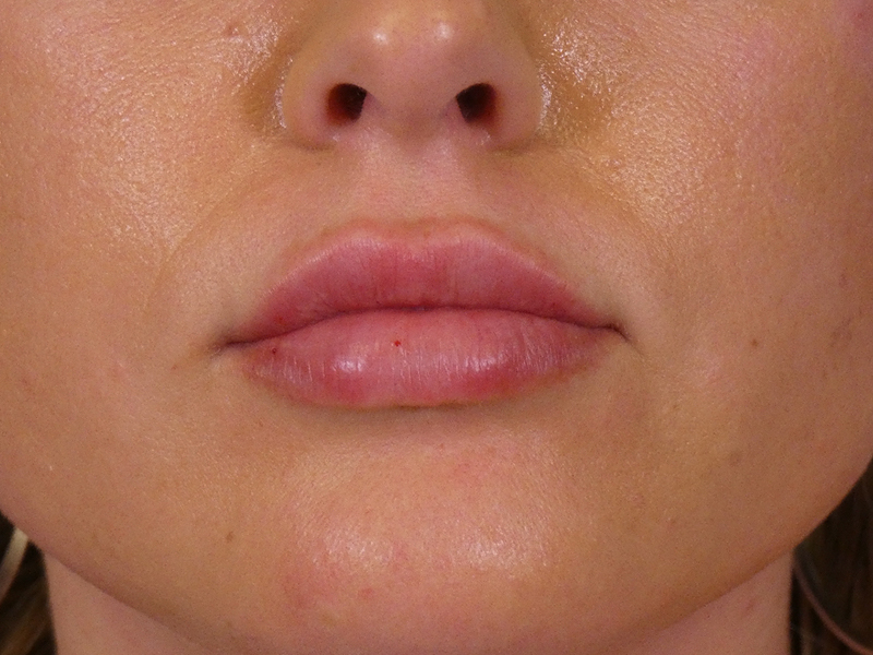 Lip Filler Before and After | Plastic Surgery Associates of Valdosta