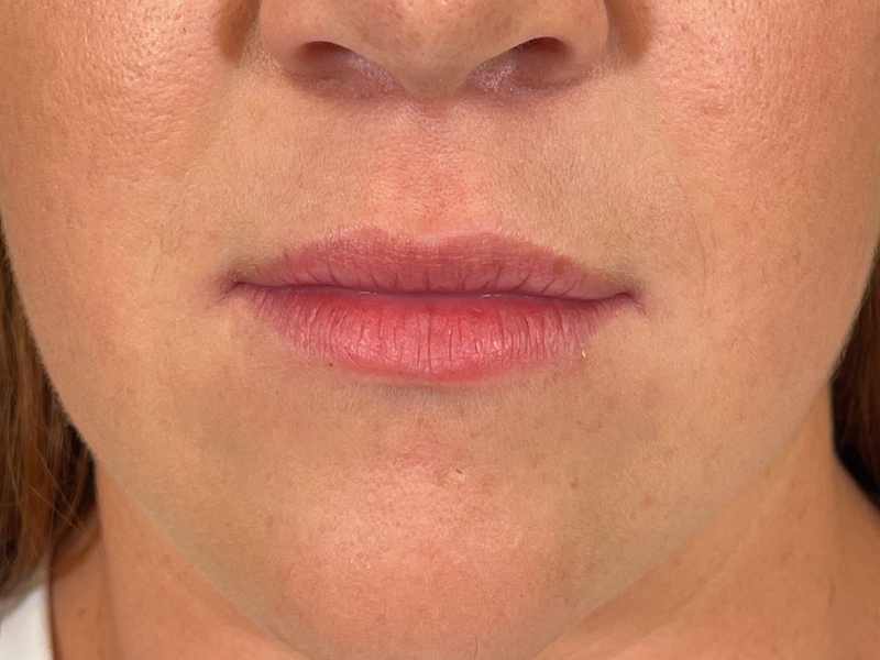 Lip Filler Before and After | Plastic Surgery Associates of Valdosta