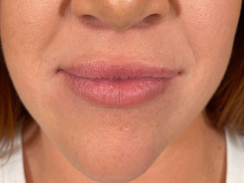 Lip Filler Before and After | Plastic Surgery Associates of Valdosta