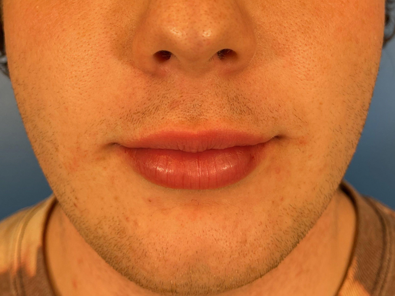 Lip Filler Before and After | Plastic Surgery Associates of Valdosta