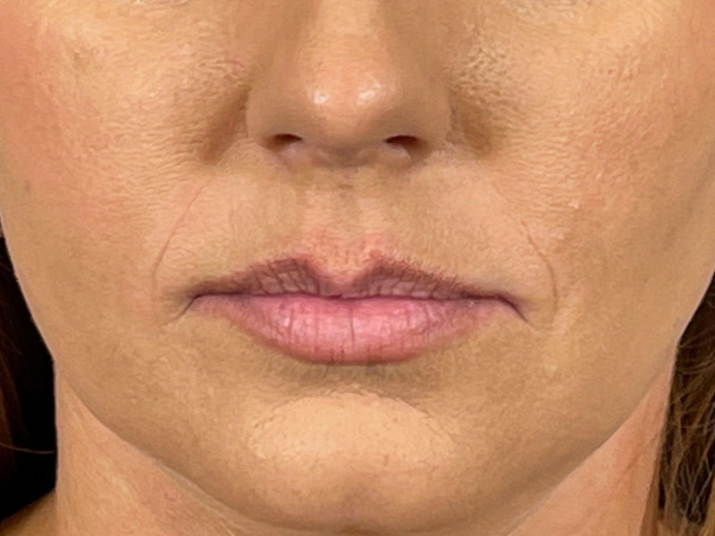 Lip Filler Before and After | Plastic Surgery Associates of Valdosta