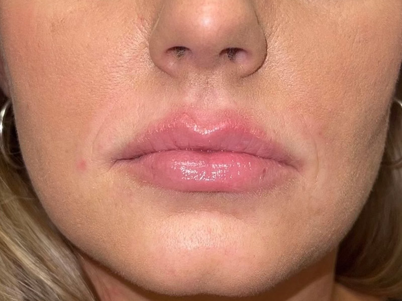 Lip Filler Before and After | Plastic Surgery Associates of Valdosta