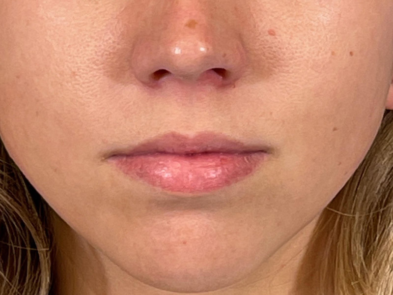 Lip Filler Before and After | Plastic Surgery Associates of Valdosta