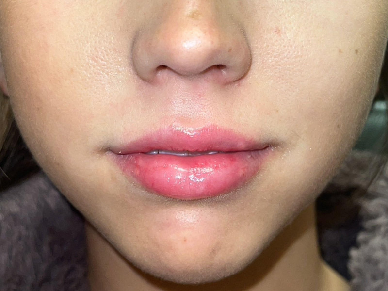 Lip Filler Before and After | Plastic Surgery Associates of Valdosta