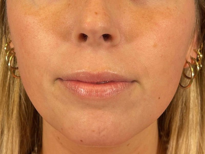 Lip Filler Before and After | Plastic Surgery Associates of Valdosta