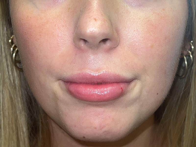 Lip Filler Before and After | Plastic Surgery Associates of Valdosta