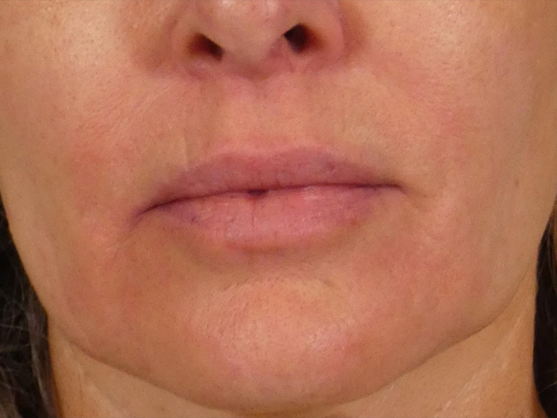 Lip Lift Before and After | Plastic Surgery Associates of Valdosta