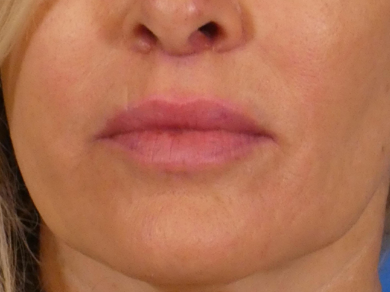 Lip Lift Before and After | Plastic Surgery Associates of Valdosta