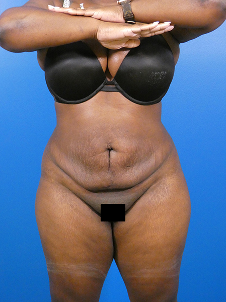 Liposuction Before and After | Plastic Surgery Associates of Valdosta