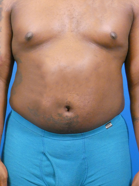 Liposuction Before and After | Plastic Surgery Associates of Valdosta