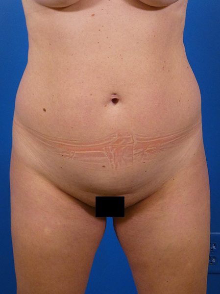 Liposuction Before and After | Plastic Surgery Associates of Valdosta