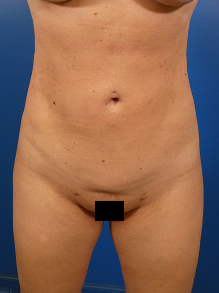 Liposuction Before and After | Plastic Surgery Associates of Valdosta