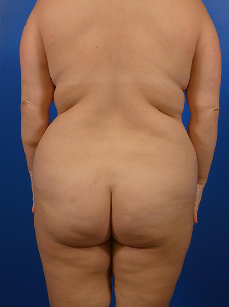 Liposuction of Back and Flanks - Associates in Plastic Surgery