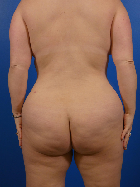 Liposuction of Back and Flanks - Associates in Plastic Surgery