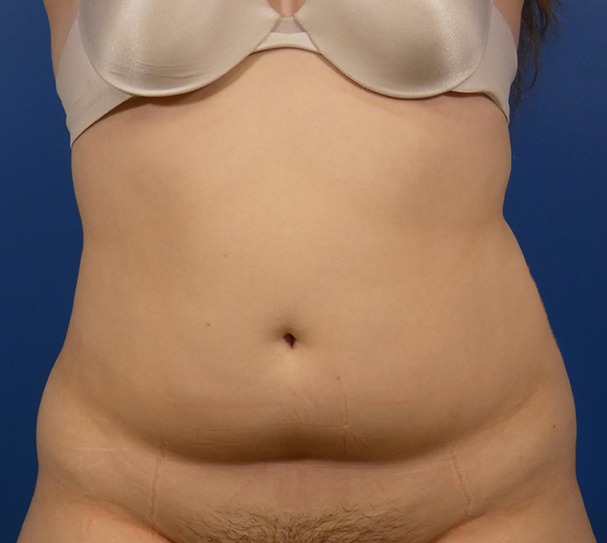 Liposuction Before and After | Plastic Surgery Associates of Valdosta