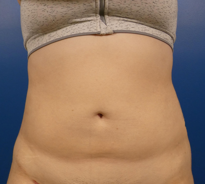 Liposuction Before and After | Plastic Surgery Associates of Valdosta