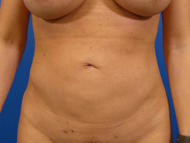 Liposuction Before and After | Plastic Surgery Associates of Valdosta