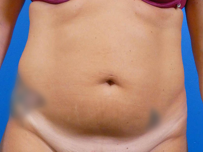 Liposuction Before and After | Plastic Surgery Associates of Valdosta