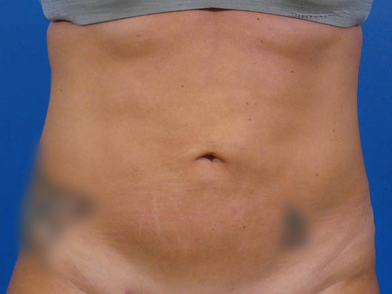 Liposuction Before and After | Plastic Surgery Associates of Valdosta