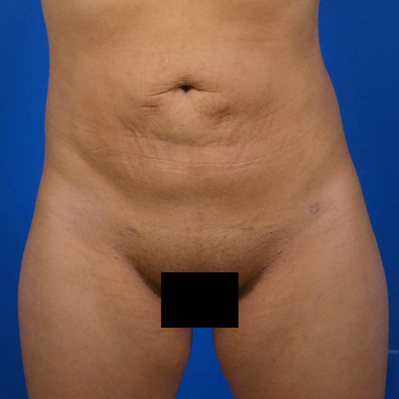 Liposuction Before and After | Plastic Surgery Associates of Valdosta