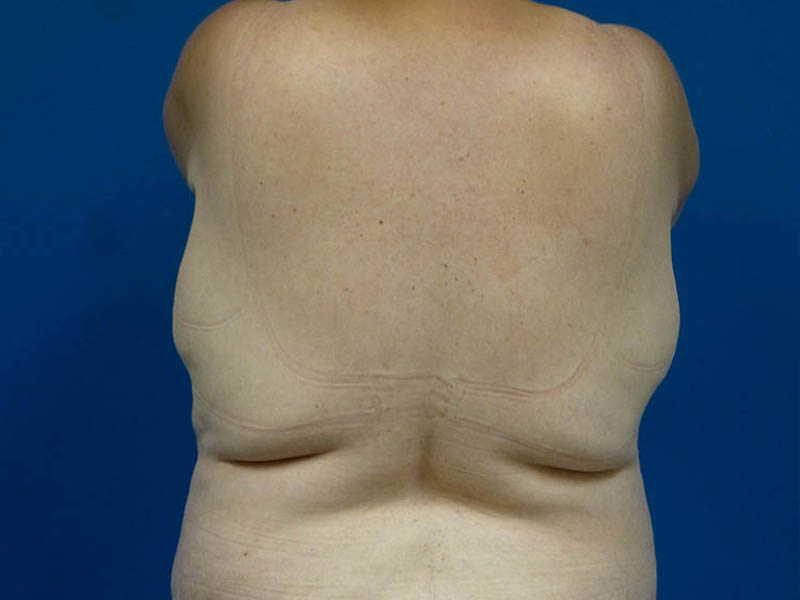 Liposuction Before and After | Plastic Surgery Associates of Valdosta