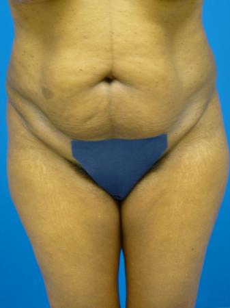 Liposuction Before and After | Plastic Surgery Associates of Valdosta