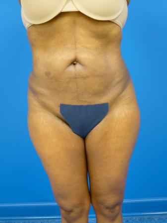 Liposuction Before and After | Plastic Surgery Associates of Valdosta