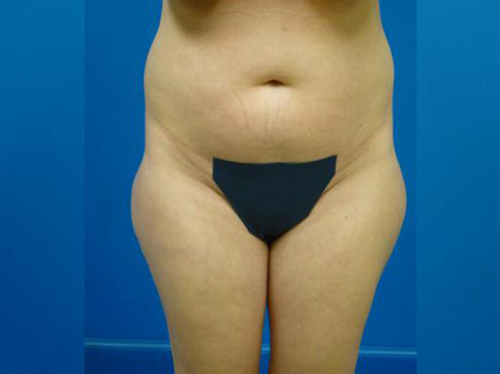 Liposuction Before and After | Plastic Surgery Associates of Valdosta