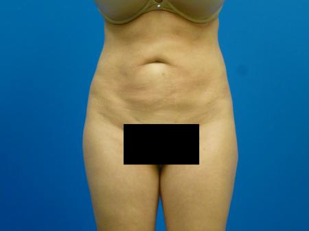 Liposuction Before and After | Plastic Surgery Associates of Valdosta