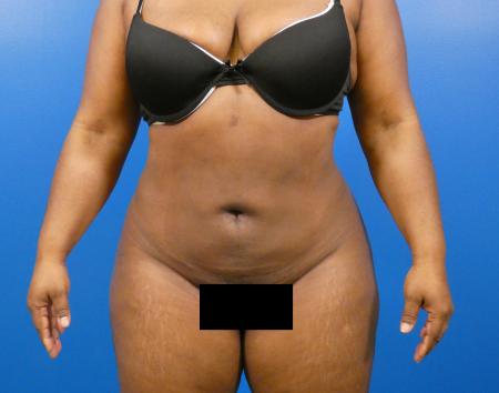 Liposuction Before and After | Plastic Surgery Associates of Valdosta