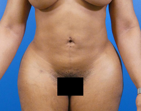 Liposuction Before and After | Plastic Surgery Associates of Valdosta