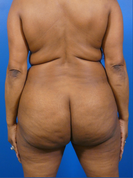 Liposuction Before and After | Plastic Surgery Associates of Valdosta