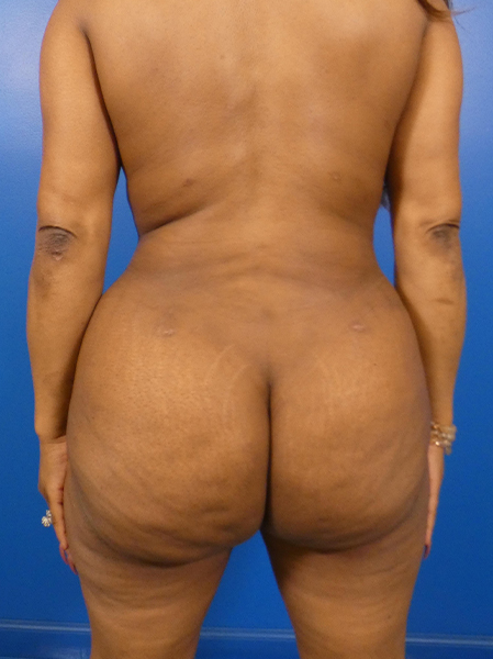 Liposuction Before and After | Plastic Surgery Associates of Valdosta