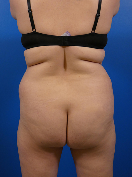 Liposuction Before and After | Plastic Surgery Associates of Valdosta