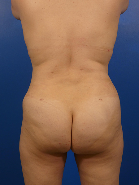 Liposuction Before and After | Plastic Surgery Associates of Valdosta