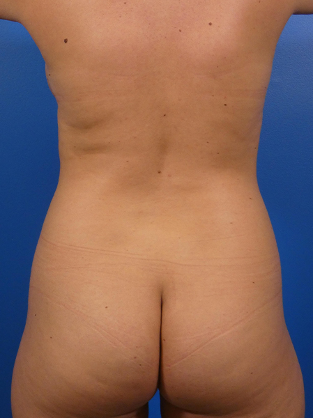 Liposuction Before and After | Plastic Surgery Associates of Valdosta