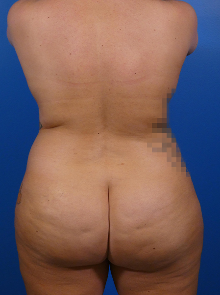 Liposuction Before and After | Plastic Surgery Associates of Valdosta