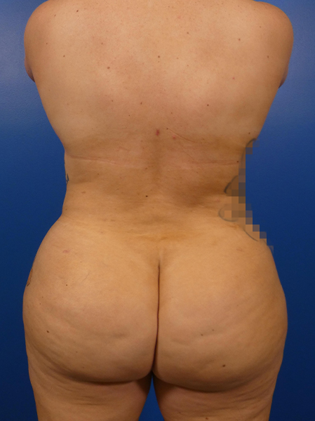 Liposuction Before and After | Plastic Surgery Associates of Valdosta