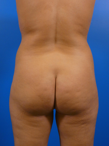 Liposuction Before and After | Plastic Surgery Associates of Valdosta