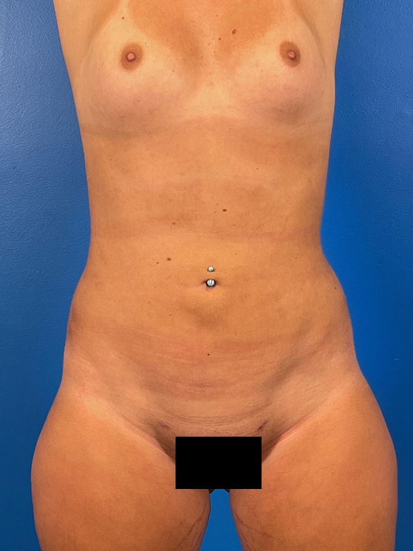 Liposuction Before and After | Plastic Surgery Associates of Valdosta